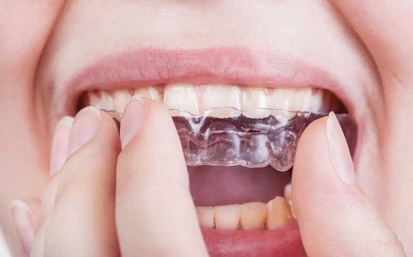 Diş teli takıyorsanız kesinlikle elinizin altında karbonat bulundurmanız gerekiyor